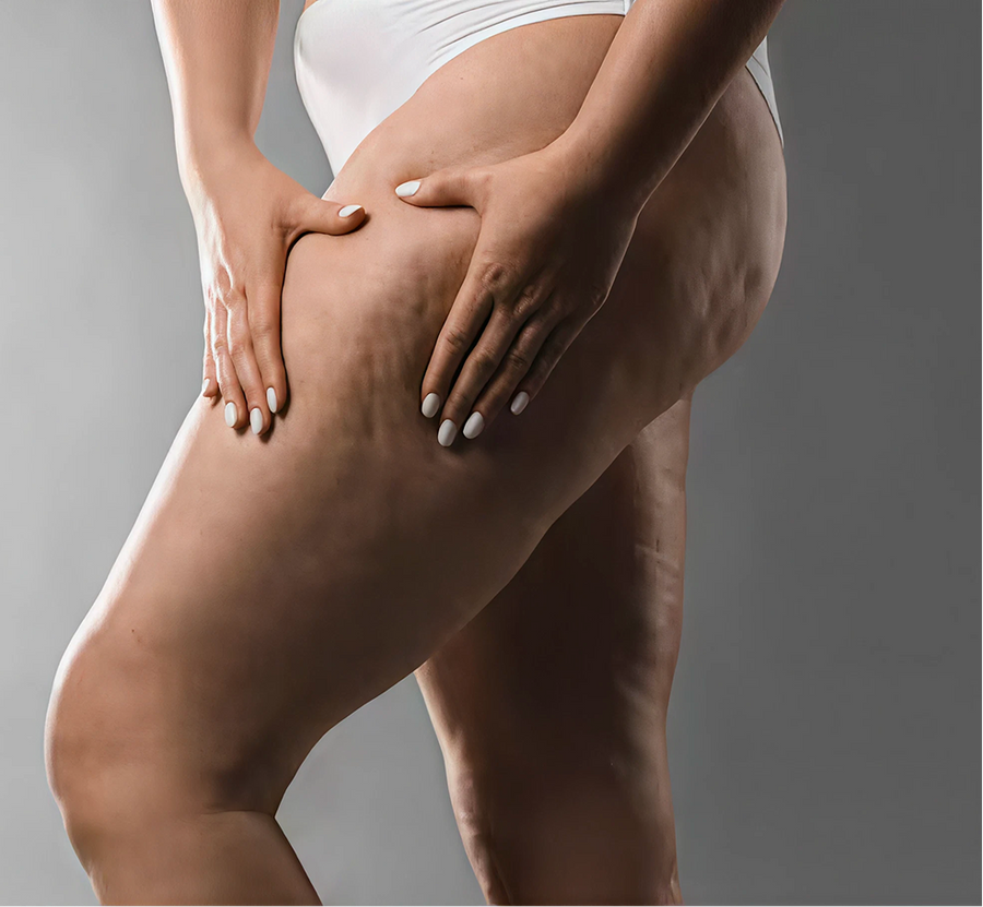 Cellulite